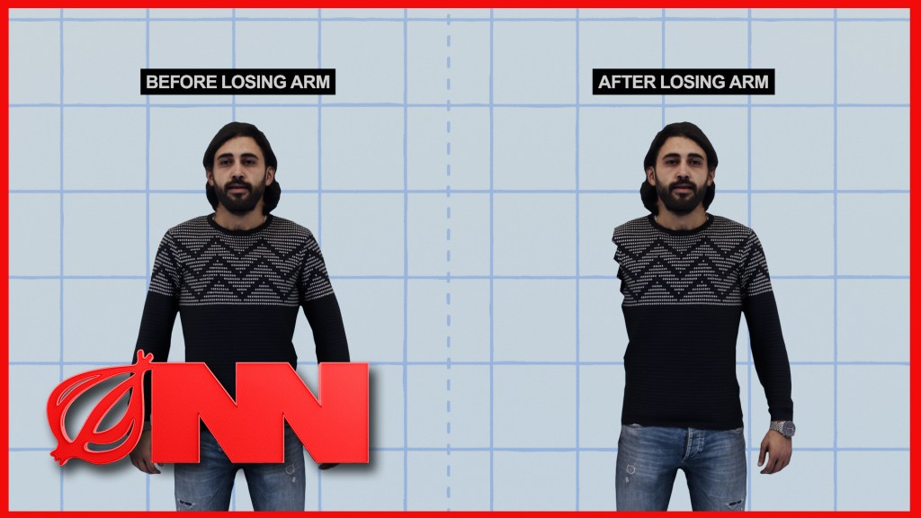 Report: You Could Just Lose An Arm One Day